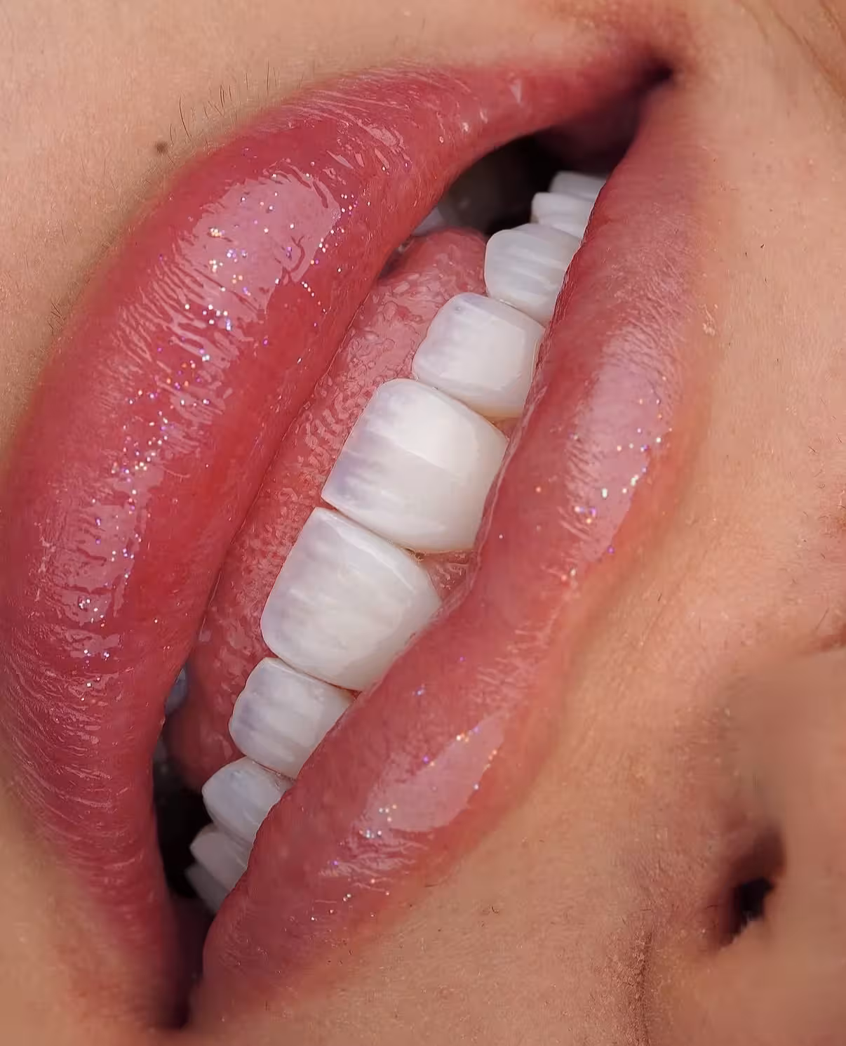 Dental Tourism in Georgia: Why International Patients Choose Tbilisi for Their New Smile