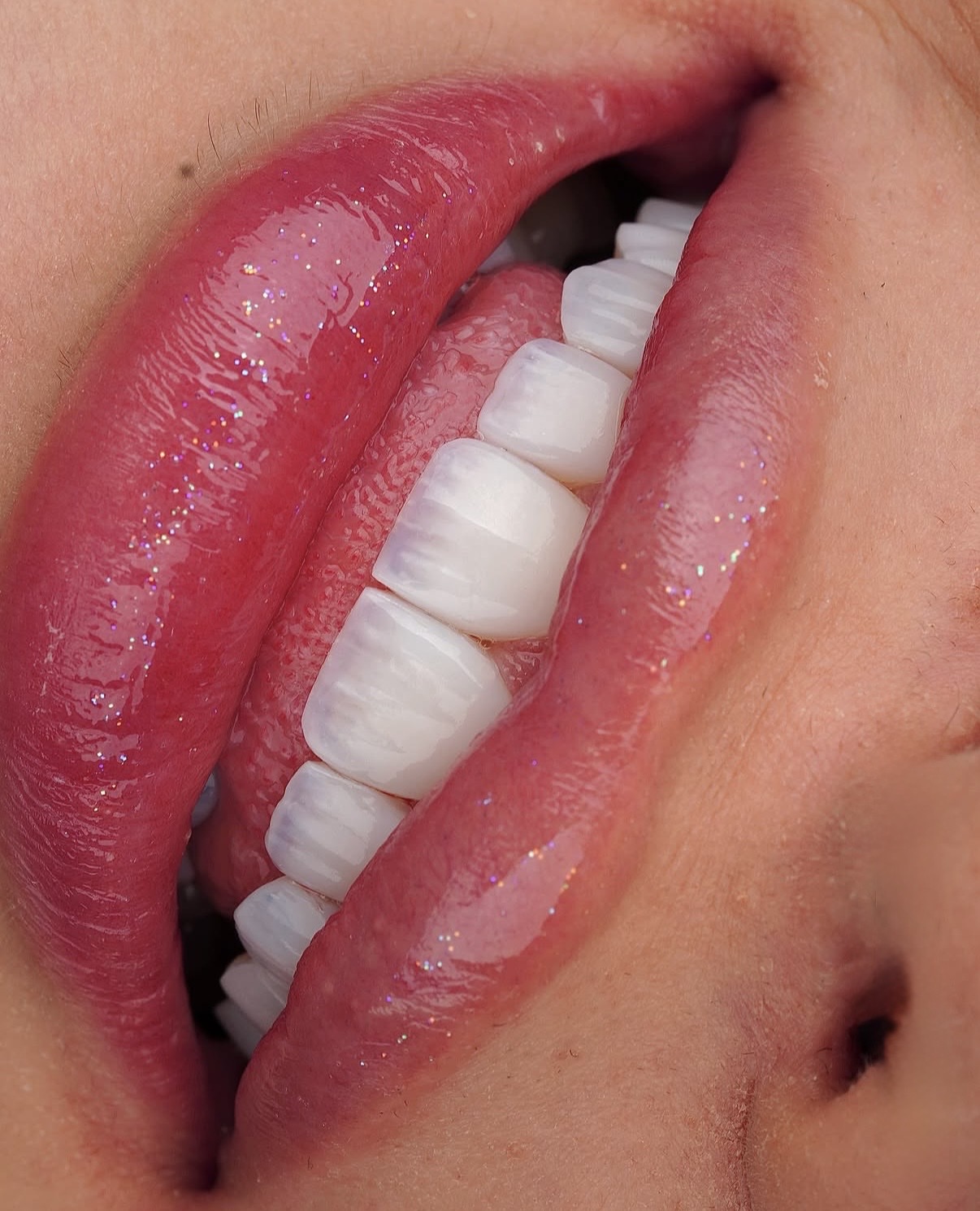 Dental Tourism in Georgia: Why International Patients Choose Tbilisi for Their New Smile
