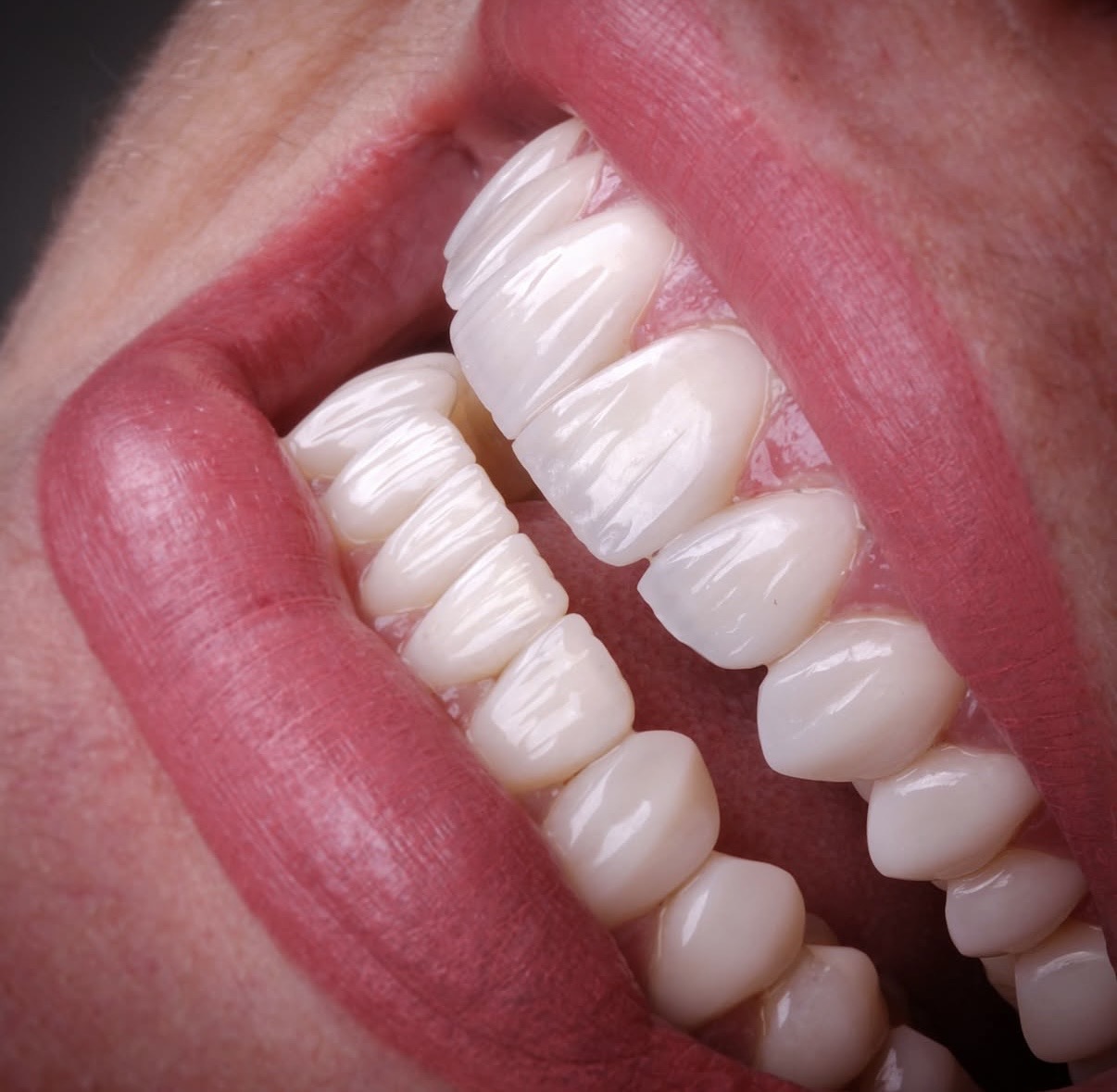 How Long Does It Take to Get Dental Implants in Georgia? | BuchoDenti