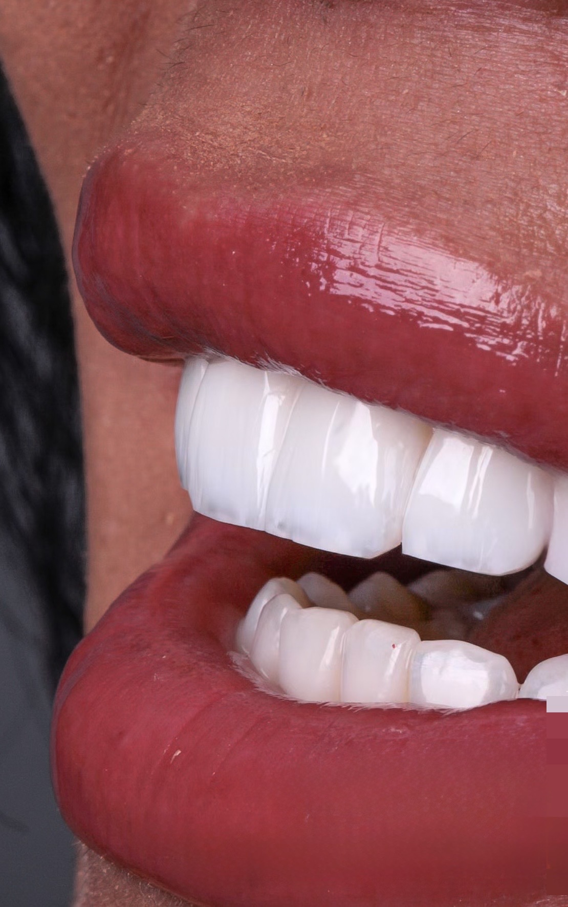 Dental Implants in Georgia: What International Patients Need to Know Before Treatment