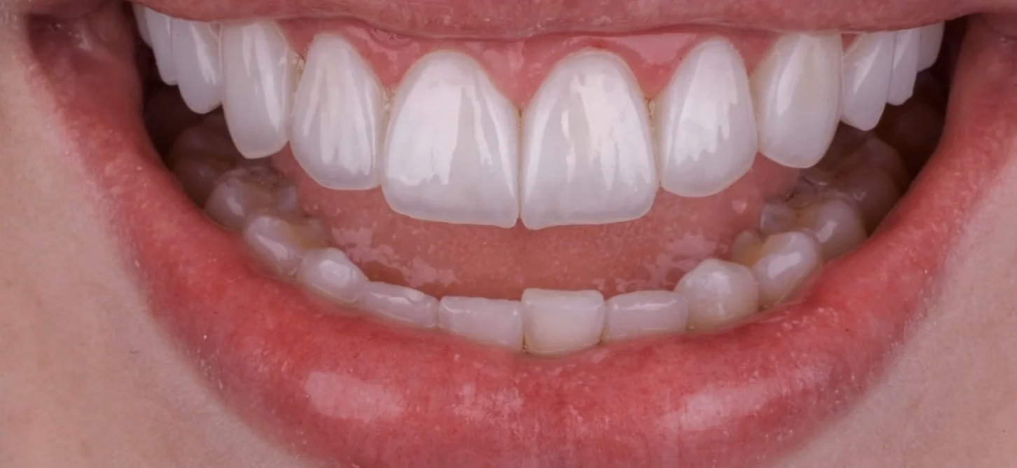 Dental Implants in Georgia for International Patients | BuchoDenti Tbilisi