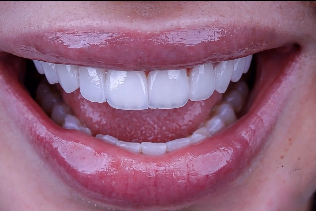 Dental Implant Treatment in Georgia Step by Step | BuchoDenti