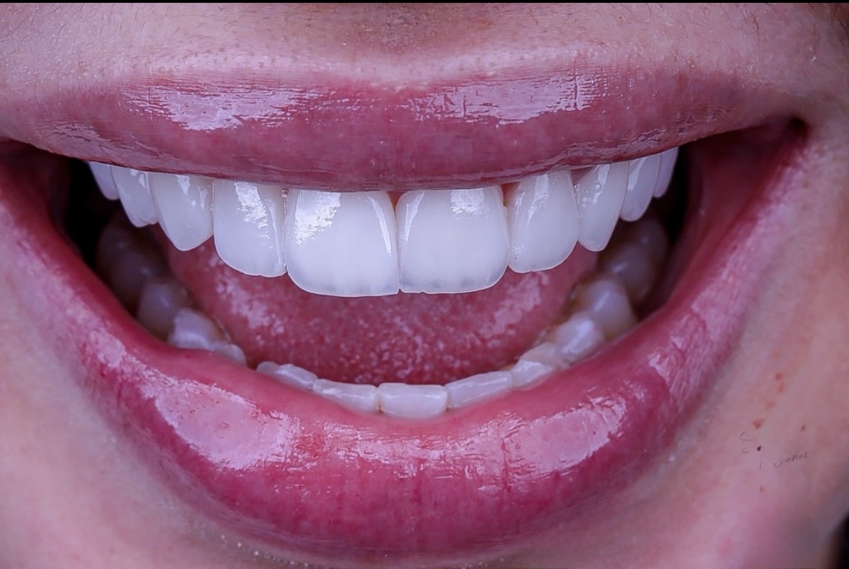 Dental Implant Treatment in Georgia Step by Step | BuchoDenti