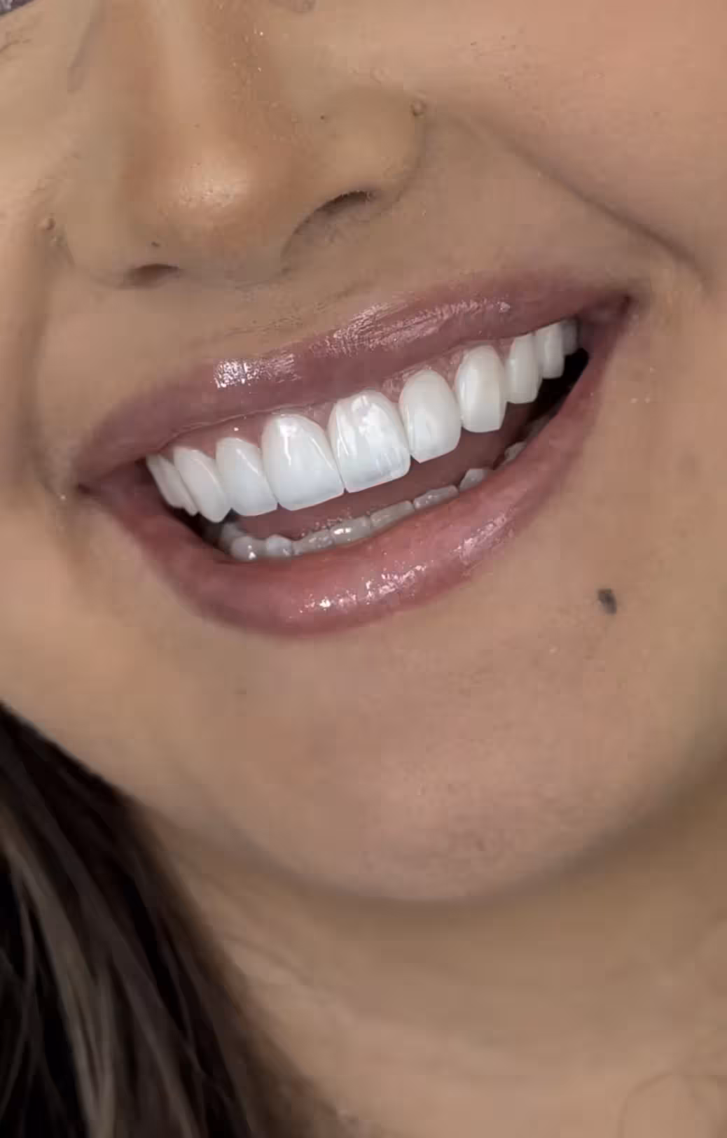 Why International Patients Choose BuchoDenti for Dental Implants in Georgia