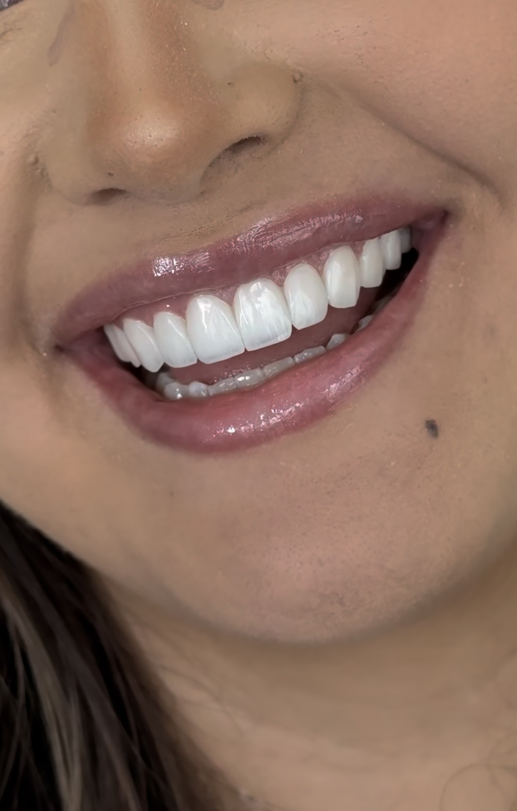 Why International Patients Choose BuchoDenti for Dental Implants in Georgia