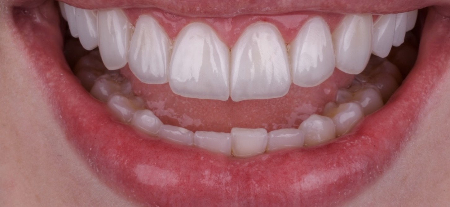 Dental Implant Journey in Georgia | From Online Consultation to Your New Smile