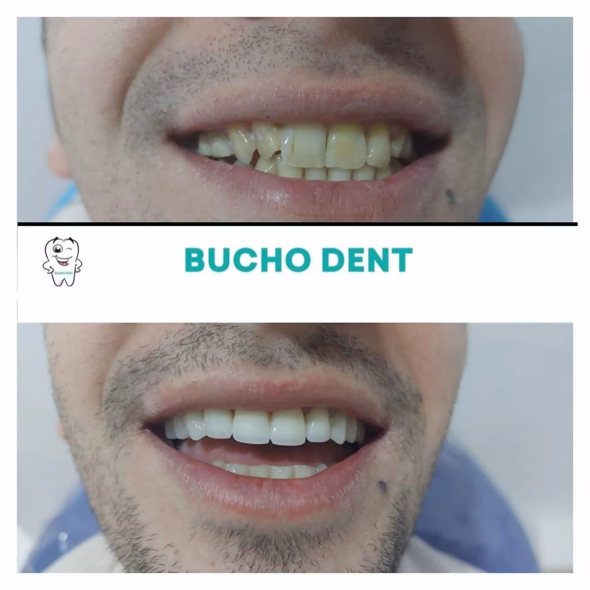 Dental Implants in Georgia: Why International Patients Trust BuchoDenti