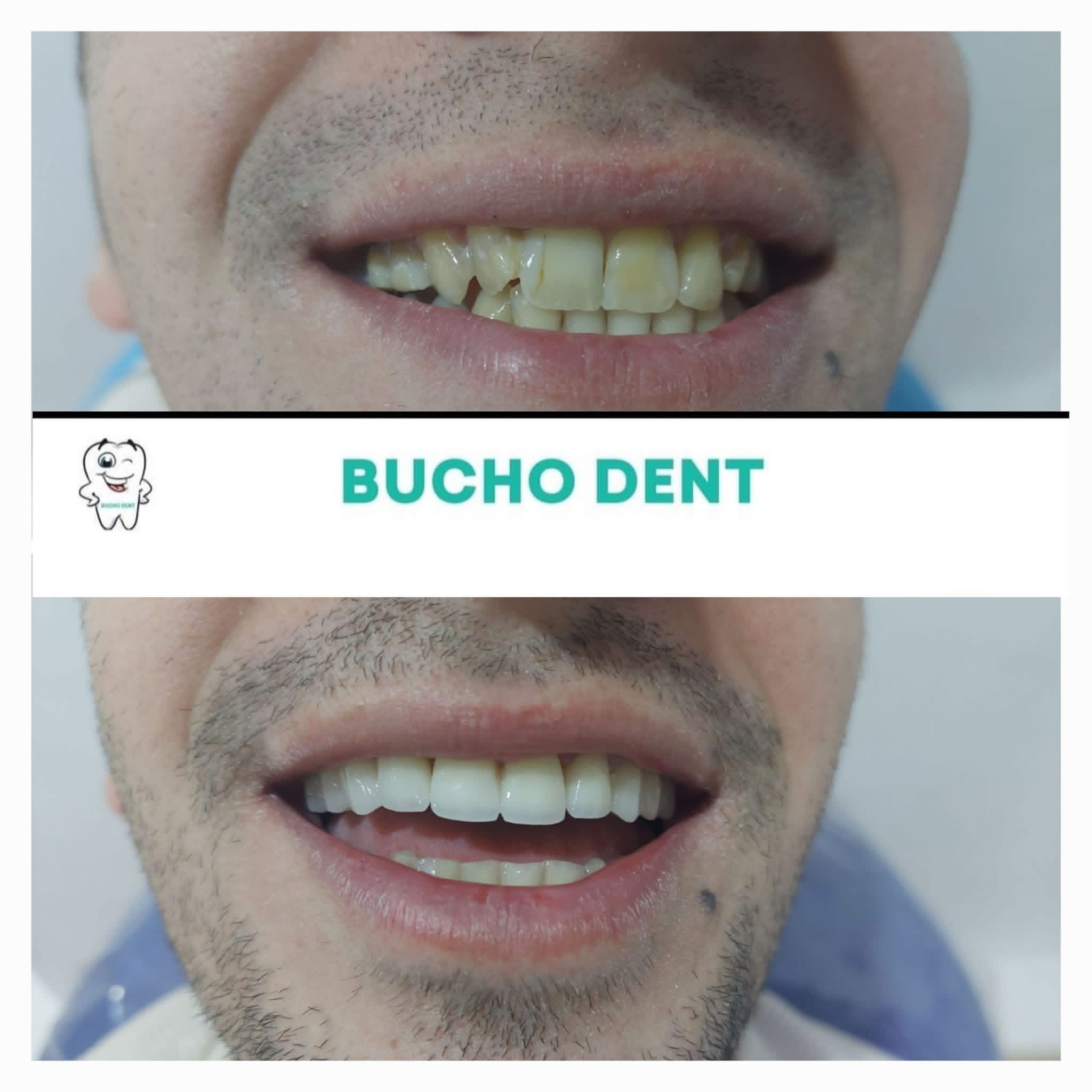 Dental Implants in Georgia: Why International Patients Trust BuchoDenti
