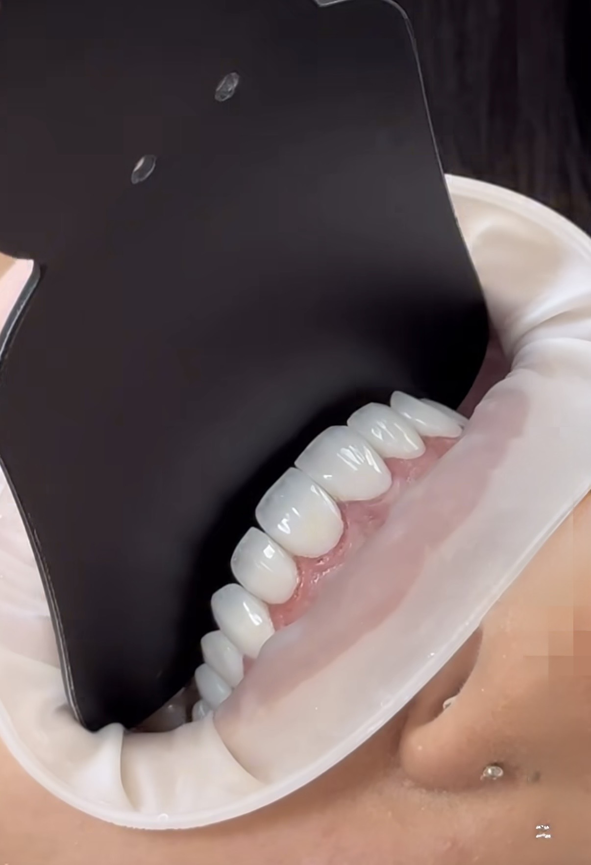   Real Patient Experience with Dental Implants in Georgia | BuchoDenti