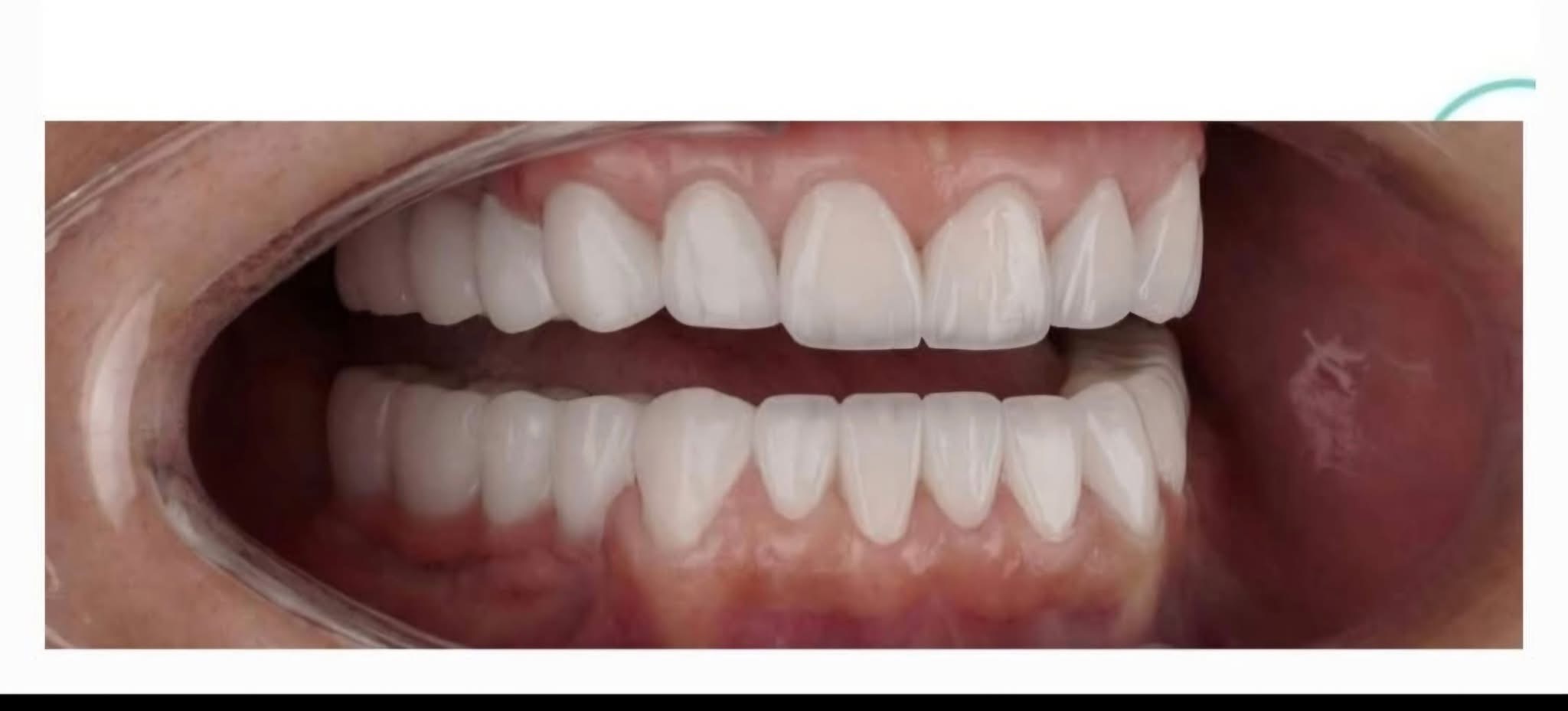 How to Choose the Right Dental Implant Clinic in Georgia | BuchoDenti