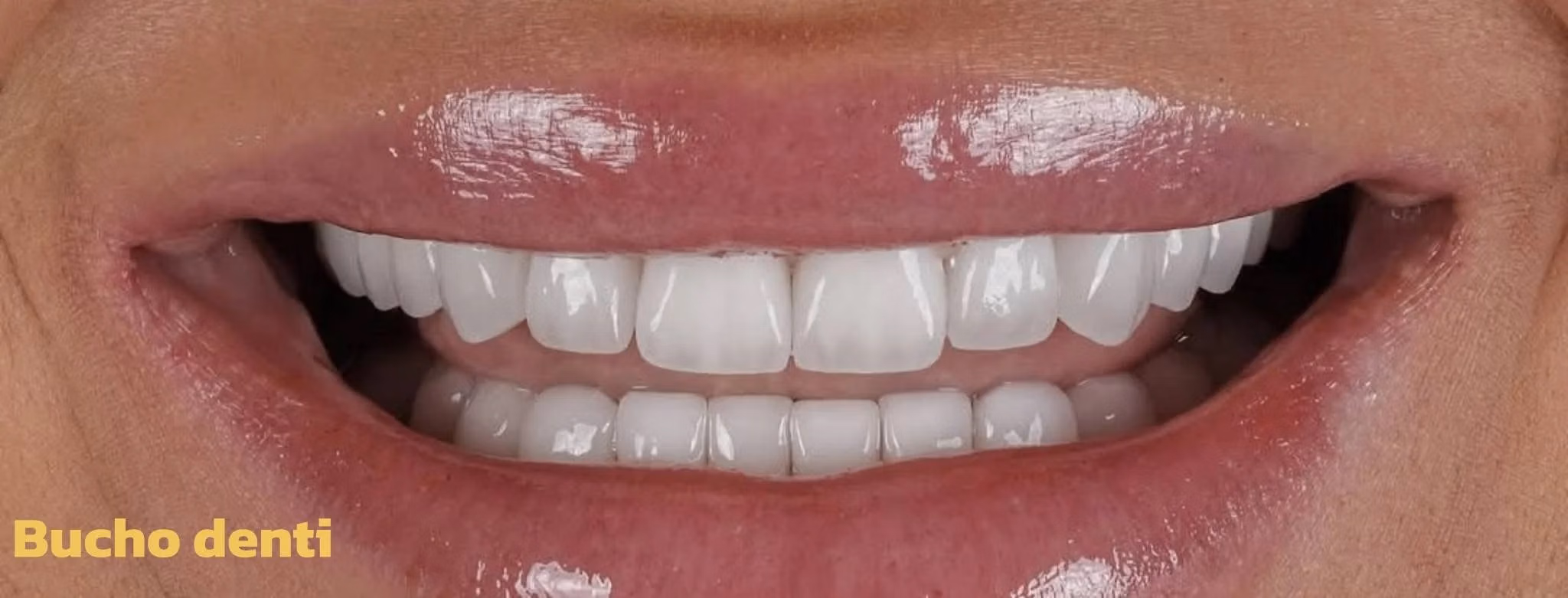 How to Choose the Right Dental Implant Treatment in Georgia