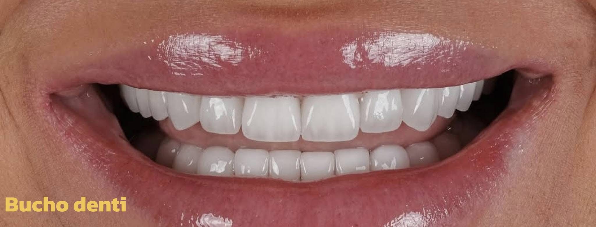 How to Choose the Right Dental Implant Treatment in Georgia