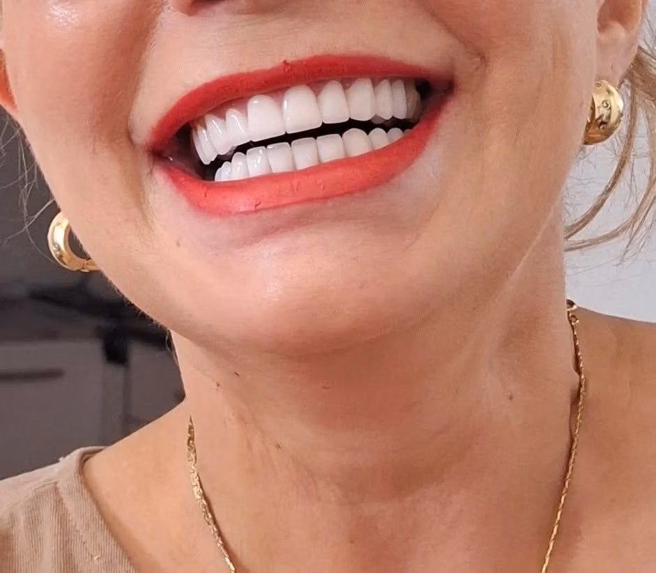 Dental Implants in Georgia: What International Patients Should Look For