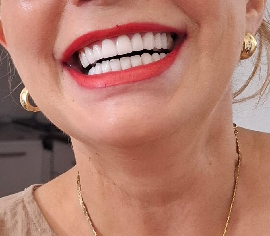 Dental Implants in Georgia: What International Patients Should Look For