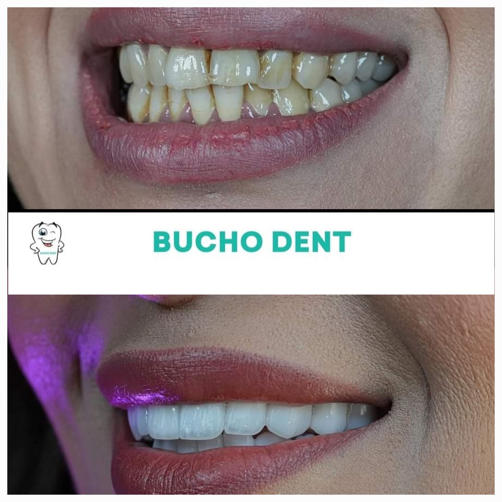 Why International Patients Need More Than a Dental Implant Price