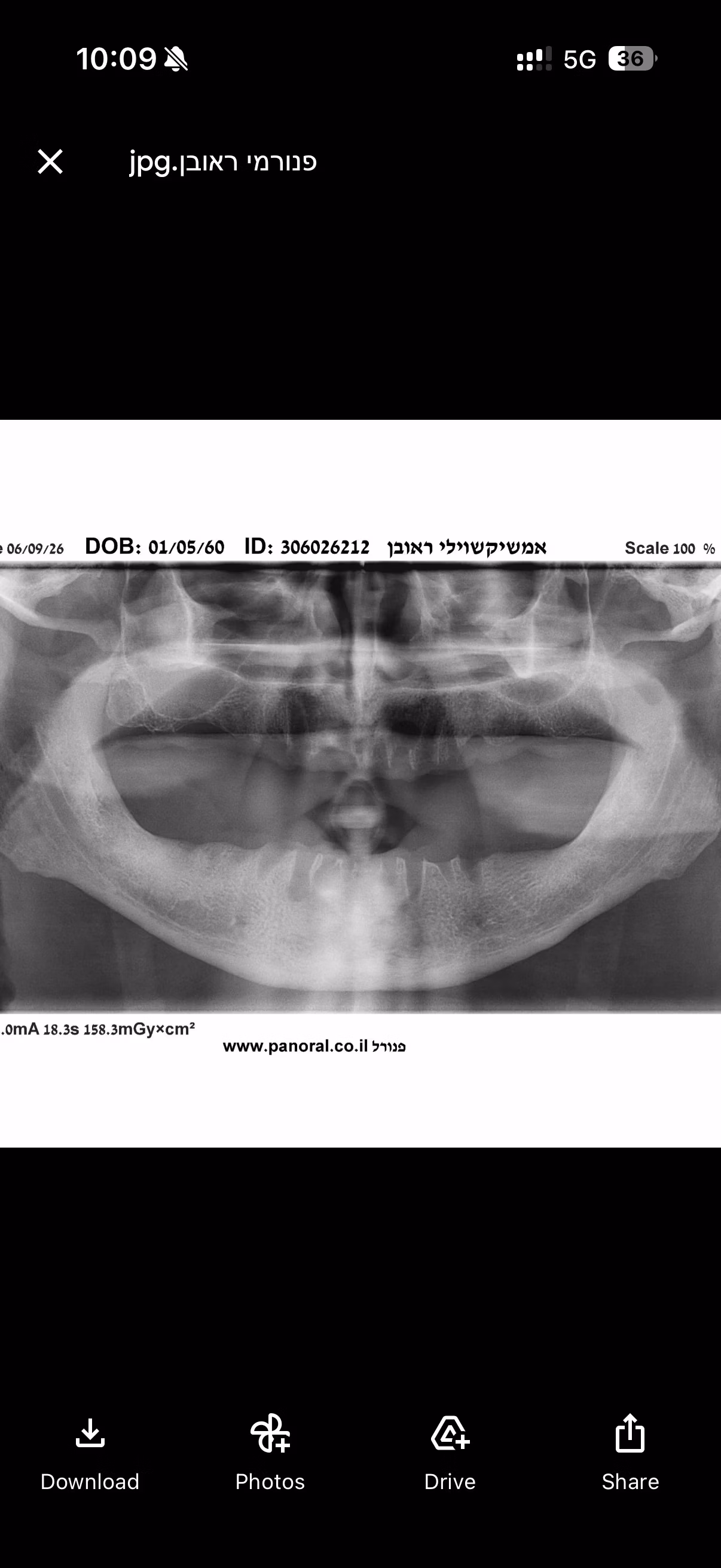 How Long Does Dental Implant Treatment Take in Georgia? | BuchoDenti Tbilisi
