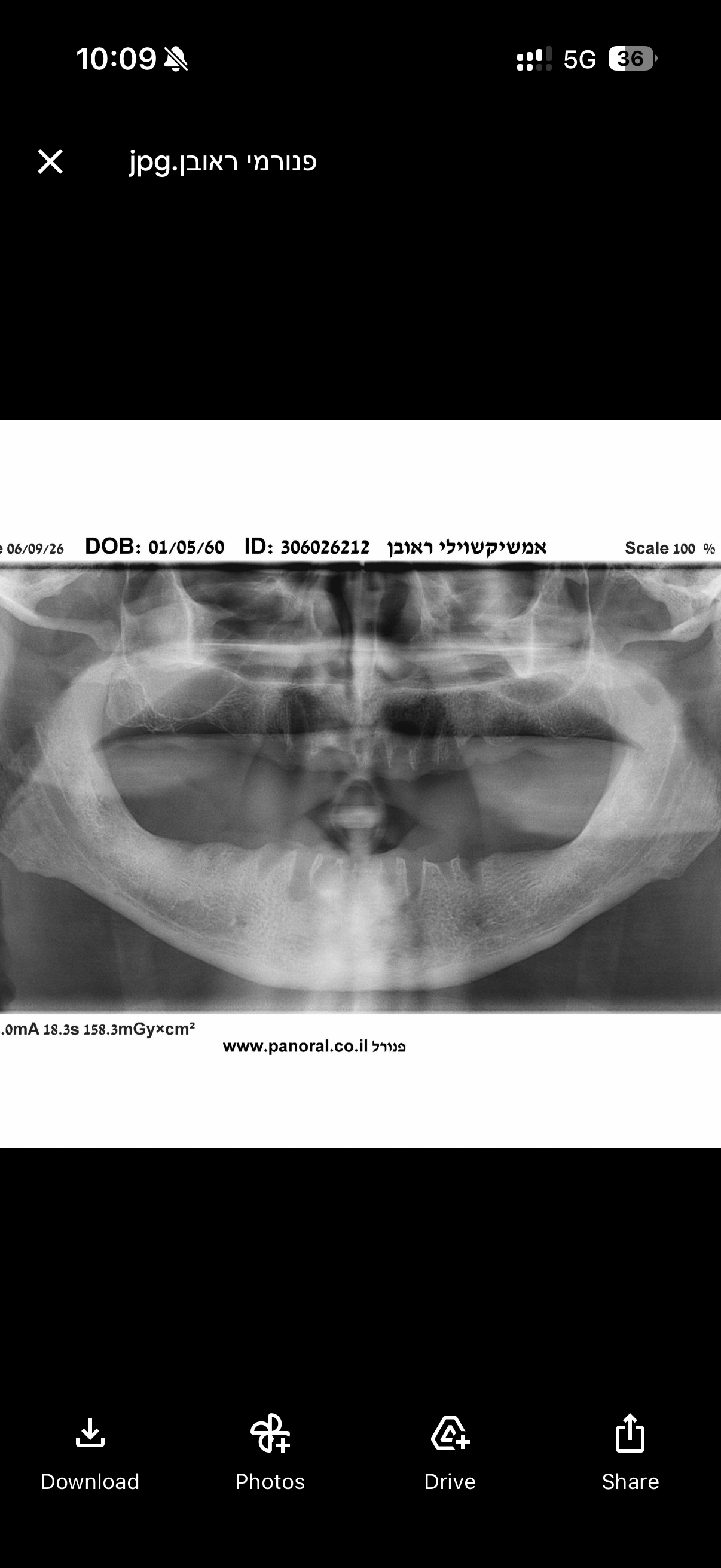 How Long Does Dental Implant Treatment Take in Georgia? | BuchoDenti Tbilisi