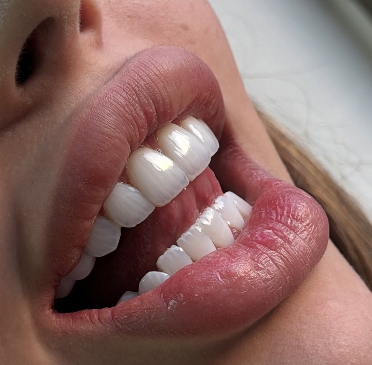 Real International Patient Journey: Dental Implants in Georgia from Arrival to New Smile