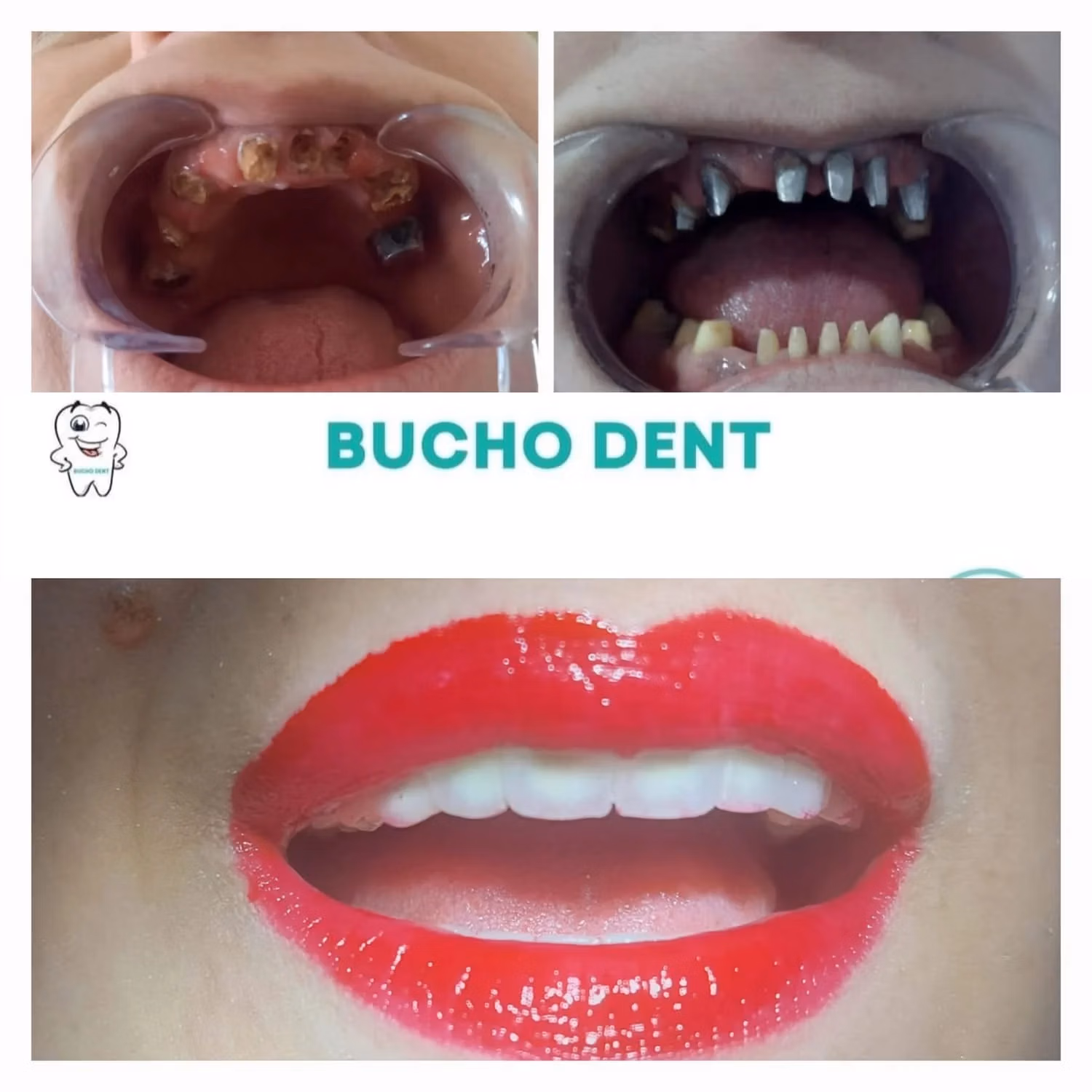 Dental Implants in Georgia: How BuchoDenti Builds a Personalized Treatment Plan for International Patients