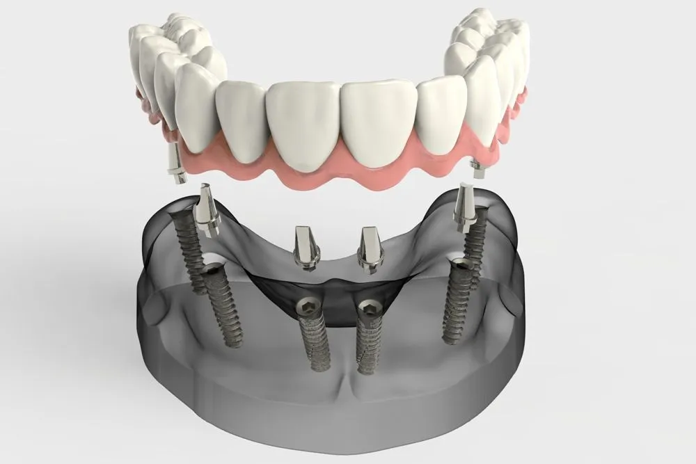 იმპლანტაცია - Dental Service Tbilisi